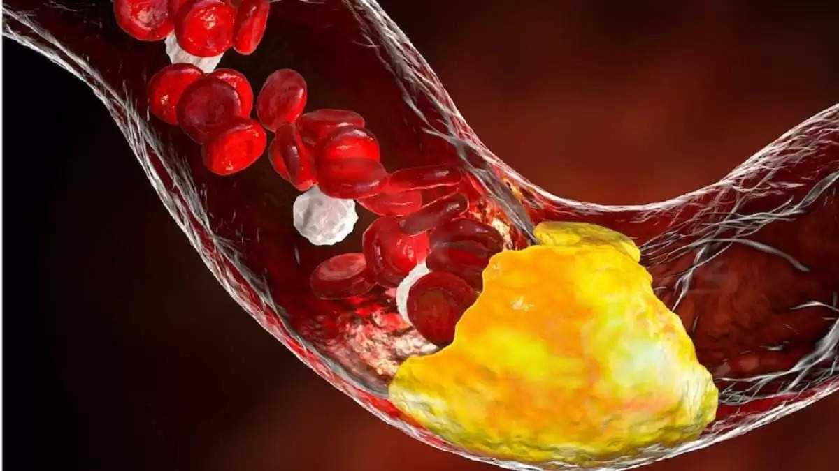 Cholesterol: इन फूड्स से हर हाल में बना लें दूरी, वरना बैड कोलेस्ट्रॉल ले सकता है आपकी जान